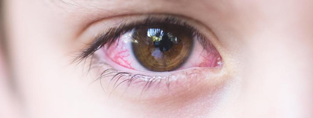 all you need to know about pink eye