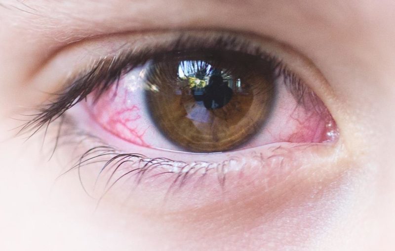 All You Need To Know About Pink Eye